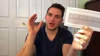 Understanding EKG rhythms