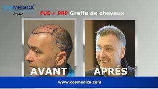 Cosmedica Dr Acar - 3000 greffons. Greffe de cheveux (implant capillaire), Turquie Istanbul