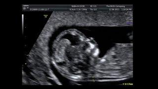 Nuchal Translucency Scan (11 Weeks - 14 Weeks)