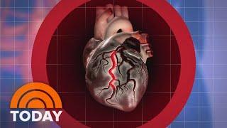 Why are young, healthy adults experiencing a rise in heart attacks?