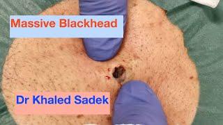 Large Blackhead removal. Dr Khaled Sadek. LipomaCyst.com