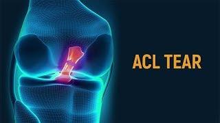 What Causes An ACL Tear?