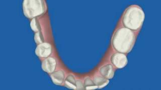 Invisalign ClinCheck - Unterkiefer