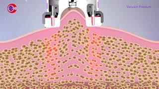 How Vacuum RF Fat Reduction Skin Tightening Treatment Work|Slimming Lymphatic Drainage Machine