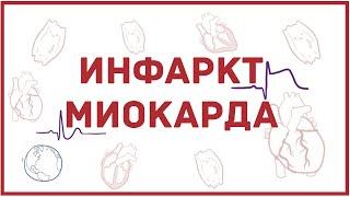 Инфаркт миокарда - обзорно - причины, патофизиология, симптомы, ЭКГ