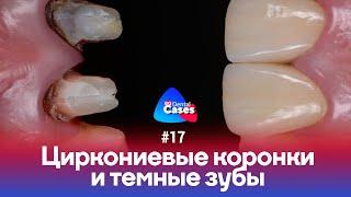 Циркониевые коронки и темные зубы | Дентал Кейсы от BG #17