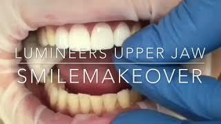 Lumineers & Veneers Zahnklinik Luzern Dr.Dr.Rosanna Himmelfarb