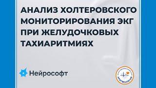 Анализ холтеровского мониторирования ЭКГ при желудочковых тахиаритмиях