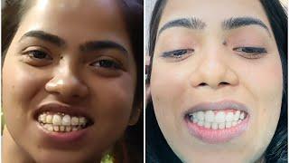 Braces removal after 3 years-2021 to 2024 braces journey of dietitian kanchan rai