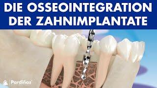 Die Osseointegration der Zahnimplantate ©