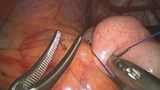 laparocopic gastric banding by Dr Craig Taylor of OClinic