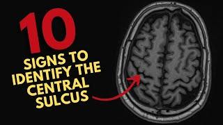 How to find the central sulcus on MRI