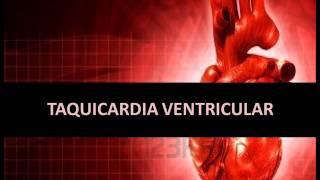 Arritmias cardíacas - Taquicardia ventricular