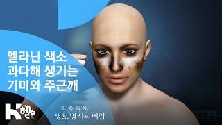 [생로병사의 비밀] - 멜라닌 색소 과다해 생기는 기미와 주근깨