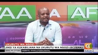 Dr Mwakio Geoffrey - Consultant Dermatologist Citizen Tv  Eczema/ukurutu