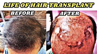 REALITY CHECK || कितने साल चलते हैं बाल HAIR TRANSPLANT के बाद? #hairtransplant