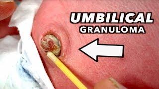 LARGE UMBILICAL GRANULOMA (Cauterized with Silver Nitrate) | Dr. Paul