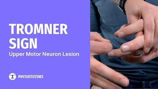 Tromner Sign | Upper Motor Neuron Lesion / Degenerative Cervical Myelopathy