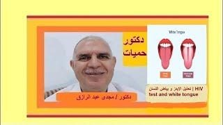 تحليل الإيدز و بياض اللسان | HIV test and white tongue