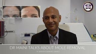 Mole Removal with Dr Maini at Zenith Cosmetic Clinics