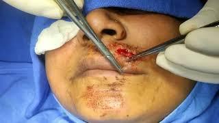 Deep Contaminated Lacerated wound with Partial Tissue loss of the Face