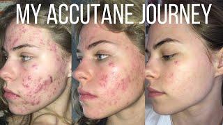 HOW I CLEARED MY ACNE | Accutane, skincare & more