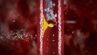 Arteriosklerose und koronare Herzkrankheit Ausschnit aus Wie erkennen Sie Störungen