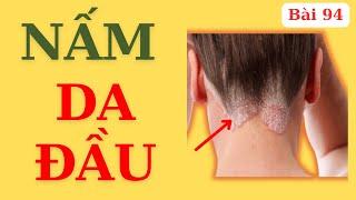 Nếu Không Có Mái Tóc Đẹp, Thì Xin Đừng Để “Nấm Da Đầu”(áp dụng được với mọi loại nấm)