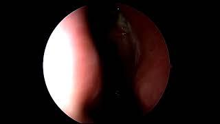 3 months after navigation guided polyps surgery by Dr Vikas Agrawal(twice operated elsewhere)