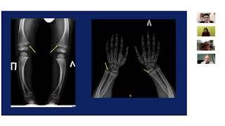 Школа клинического мышления педиатра. Гипофосфатемический рахит