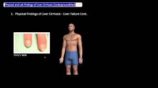 Physical and Lab Findings of Liver Cirrhosis [UndergroundMed]