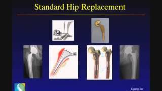 Hip Pain & Arthritis: Evaluation & Treatment