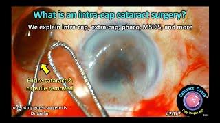 CataractCoach™ 2077: What is an intra-cap cataract surgery?