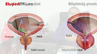 Prostat adenoması nədir və prostatın böyümə səbəbləri nələrdir?