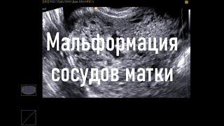 Мальформация сосудов матки. Провисание расширенных сосудов в полость матки.