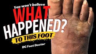 What Happened?: Abscess and Foreign Body of the Foot