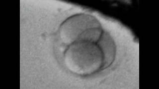 Abnormal  1st  cleavage - 3 cell human embryo after the 1st mitosis