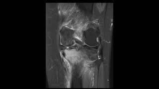 Radial tear with stress injury knee