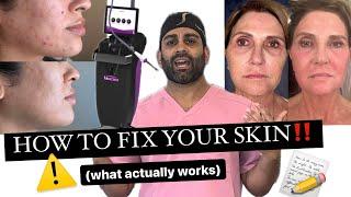 Do Laser Treatments Work!? (how to get rid of acne, scars, texture & sun damage)