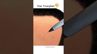 Hair transplant surgery animation short video