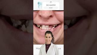 How implants and veneers can transform your smile #shorts #dental #viralvideo #trending #veneers