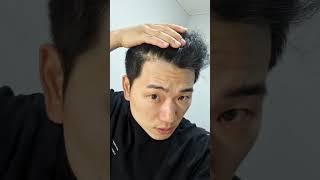 4개월 동안 먹고 난 뒤  탈모약 후기       ( 프로페시아 )