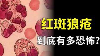 免疫系统过强引起的“狼咬”疾病竟然千年无解！【奇思诺想】