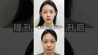 #抗衰老 #法令紋 #筋膜提升 #面部抗衰 #醫美推薦