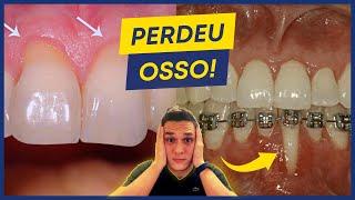 PERDA ÓSSEA AO REDOR DOS DENTES: O QUE CAUSA E COMO EVITAR?