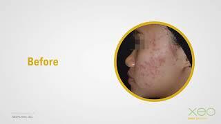 Cutera xeo® - Laser Genesys to Reduce Fineline Sun Damage