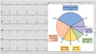 Ekg Basics Vlog 4, Lagetypbestimmung Part 2 (deutsch)