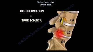 Low Back pain. Lumbar disc herniation, causes ,diagnosis ,symptoms and treatment