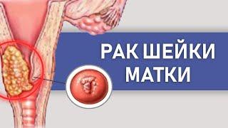 Рак шейки матки. Симптомы, диагностика, лечение и профилактика. ВПЧ. Советы гинеколога