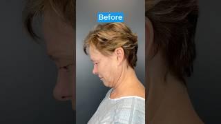 HUGE NECKLIFT TRANSFORMATION #facelift